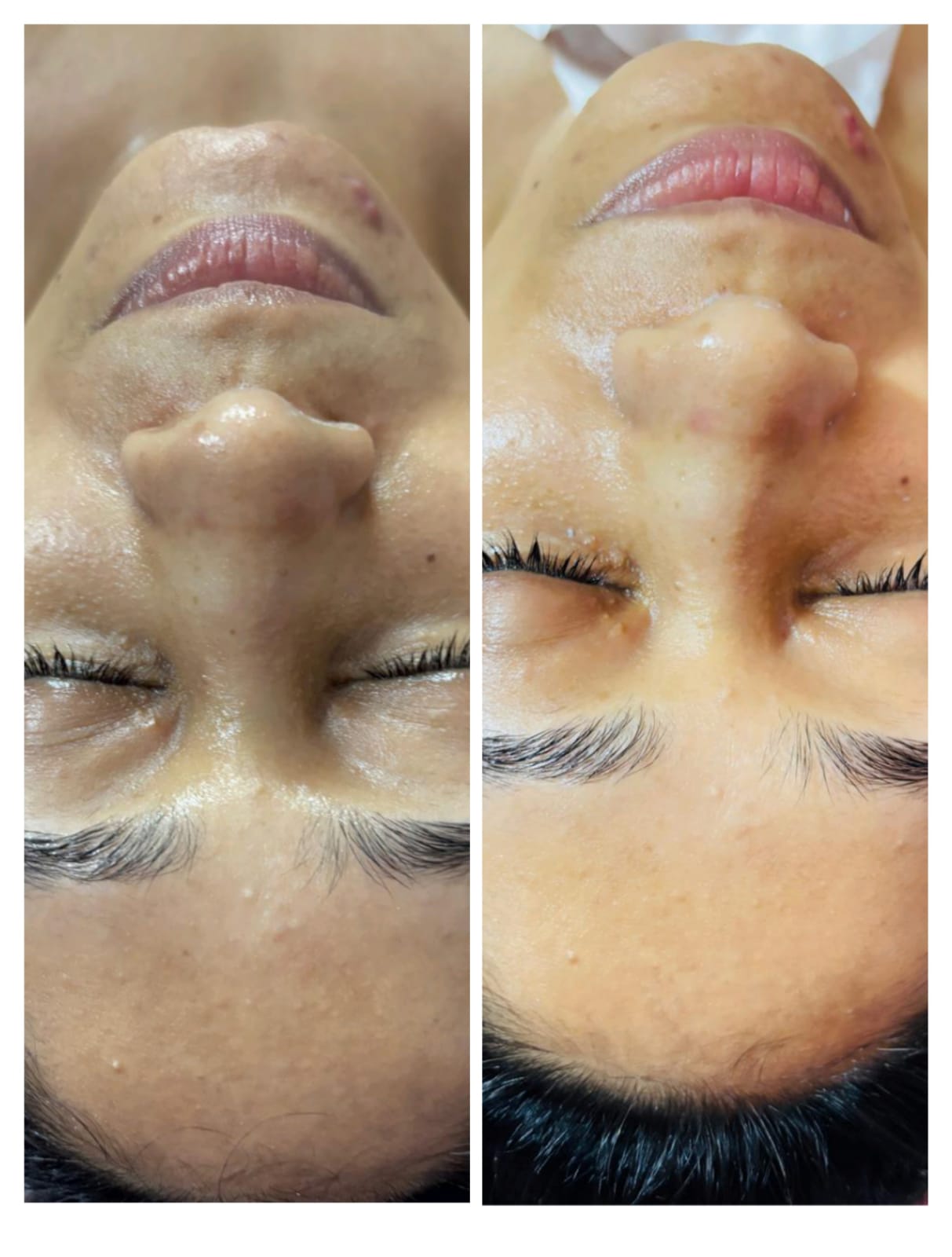 Glowing skin after Hydra Facial treatment